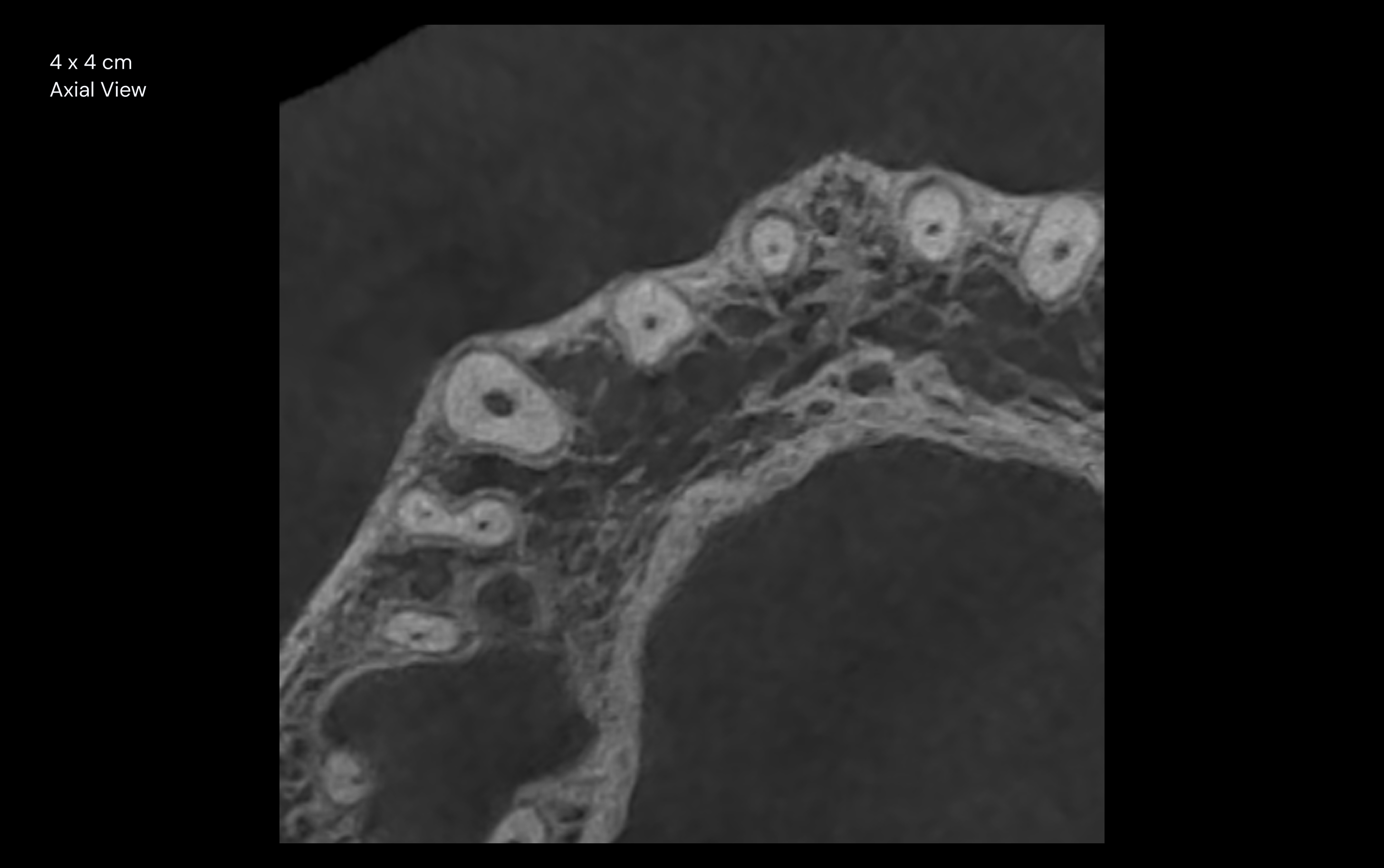 4 x 4 cm Axial View